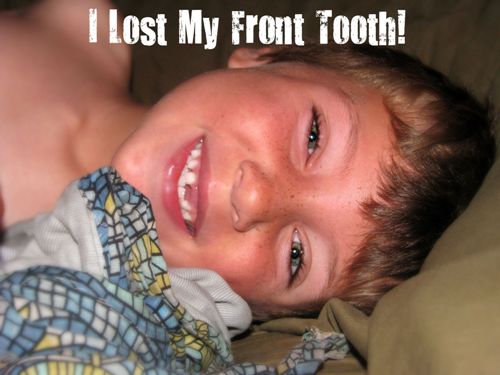 My Son Missing One of His Front Teeth